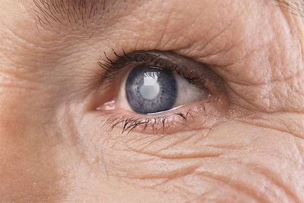 eye cataract surgery dr camille rambaud ophthalmologist paris refractive surgery and cataract