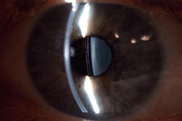 phakic implant surgery dr camille rambaud ophthalmologist paris refractive surgery and cataract